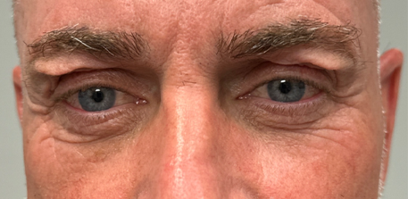 before upper bleph with subbrow filler and direct brow lift.png