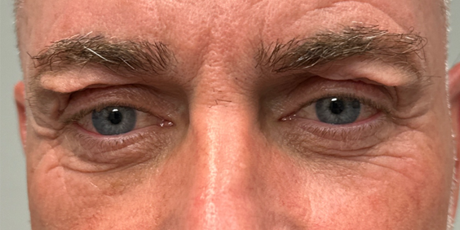 before upper bleph with subbrow filler and direct brow lift.png