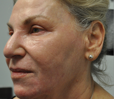 patient 1 after CO2.PNG