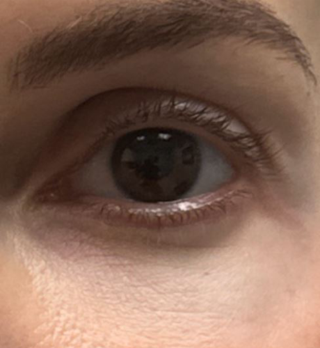 patient 1 after laser vein front.JPG