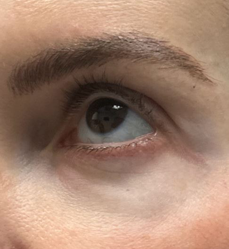 patient 1 after laser vein.JPG