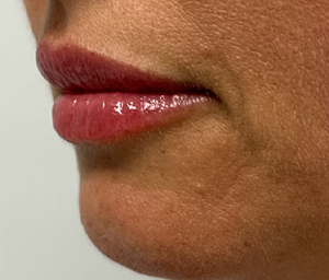 patient 1 after lip filler (left side).PNG