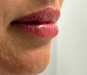 patient 1 after lip filler (right side).PNG
