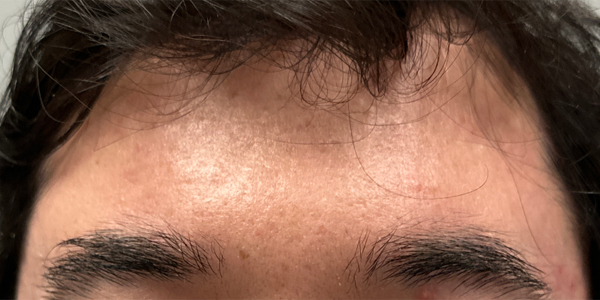 patient 1 after m8 (front).PNG