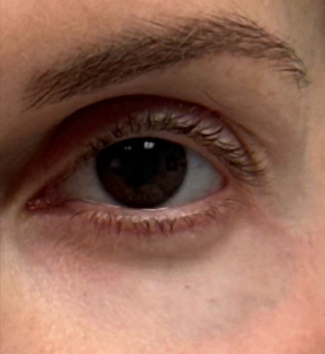 patient 1 before laser vein front.JPG
