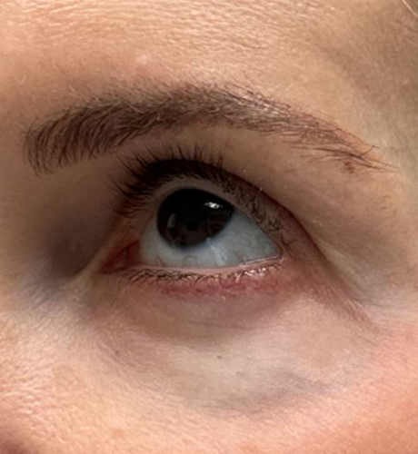 patient 1 before laser vein.JPG