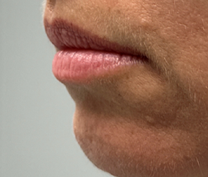 patient 1 before lip filler (left side).PNG