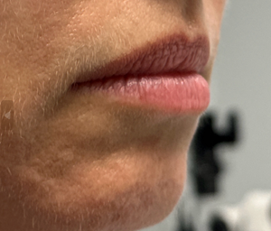patient 1 before lip filler (right side).PNG