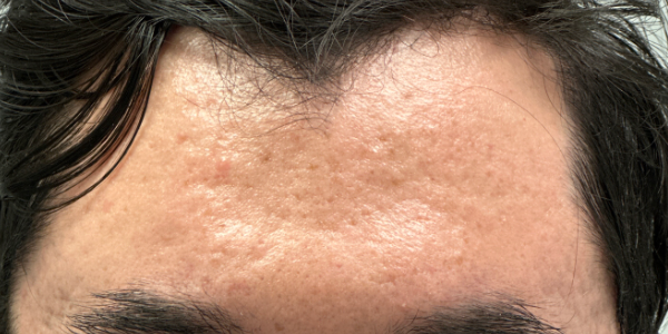 patient 1 before m8 (front).PNG