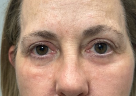 patient 10 after lower bleph with facial fat grafting and CO2 laser.png