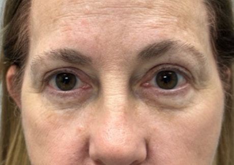 patient 10 before lower bleph with facial fat grafting and CO2 laser.png