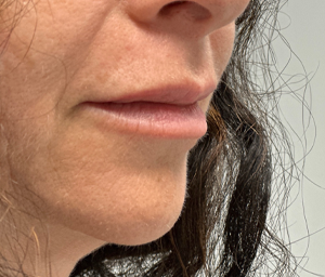patient 12 after lip filler- side.png