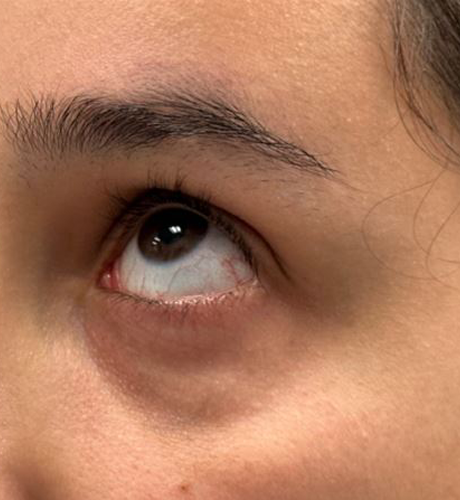 patient 2 after laser vein left.JPG