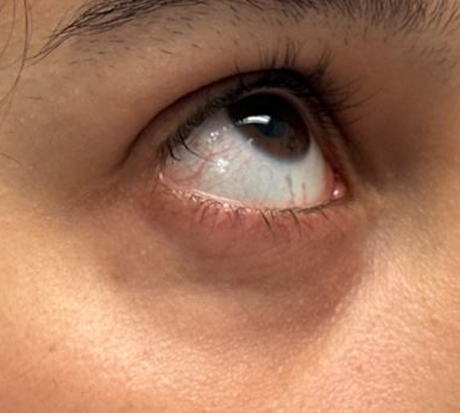 patient 2 after laser vein right.JPG