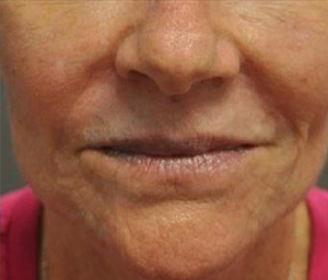 patient 2 after lip filler.PNG