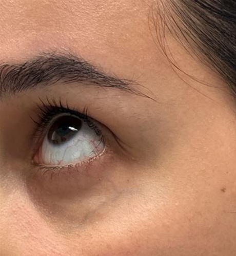 patient 2 before laser vein left.JPG