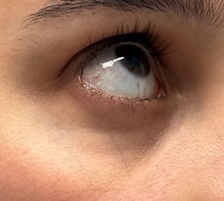 patient 2 before laser vein right.JPG