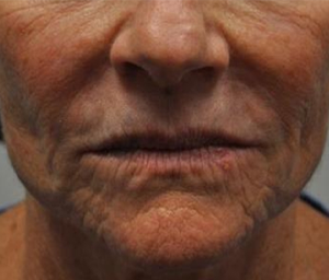 patient 2 before lip filler.PNG