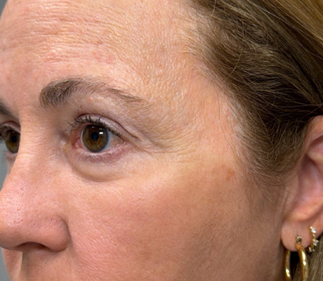 patient 22 after quad bleph with facial fat grafting and CO2 laser- side.png