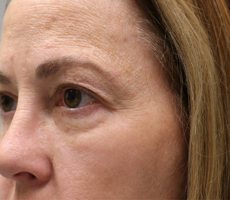 patient 22 before quad bleph with facial fat grafting and CO2 laser- side.png