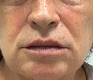 patient 3 after lip filler.PNG