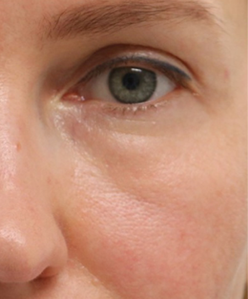 patient 3 after morpheus (for pores).PNG