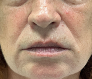 patient 3 before lip filler.PNG