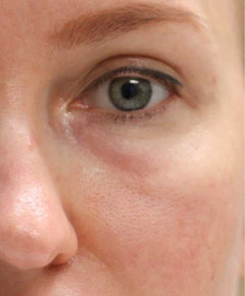 patient 3 before morpheus (for pores).PNG