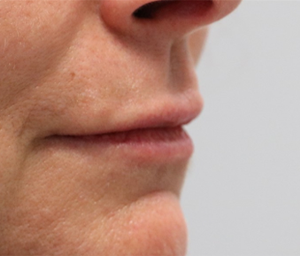 patient 4 after lip filler.PNG