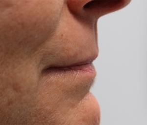 patient 4 before lip filler.PNG