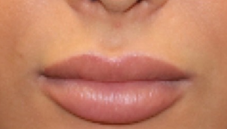 patient 5 after lip filler.PNG