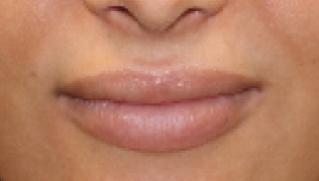 patient 5 before lip filler.PNG