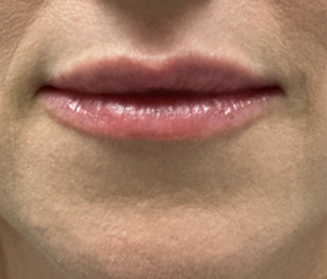 patient 6 after lip filler (front).PNG