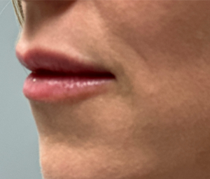 patient 6 after lip filler (side).PNG