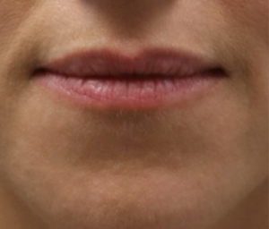 patient 6 before lip filler (front).PNG