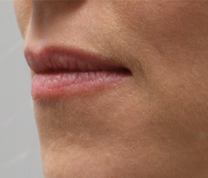 patient 6 before lip filler (side).PNG