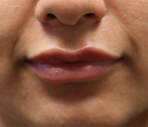 patient 7 after lip filler (after).PNG