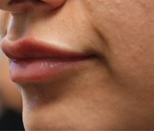 patient 7 after lip filler (side).PNG