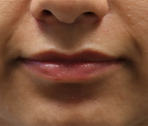 patient 7 before lip filler (front).PNG