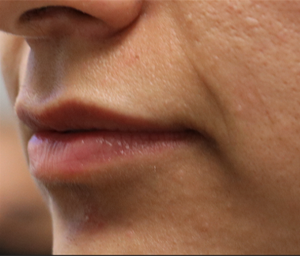 patient 7 before lip filler (side).PNG