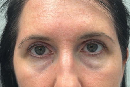 after botox and subbrow filler.png