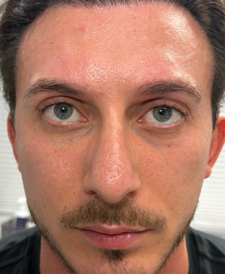 after subbrow filler.png