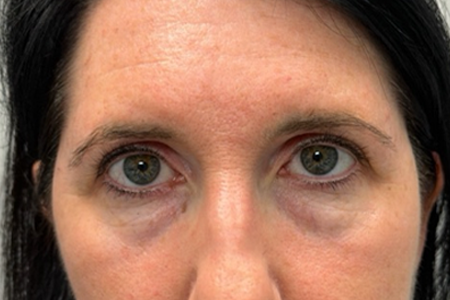 before botox and subbrow filler.png