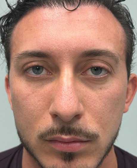 before subbrow filler.png